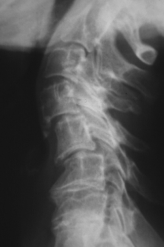 Radiographie standard de la colonne cervicale de profil. Lésions dégénératives majeures, avec sténose extrêmement serrée en C5/C6, C6/C7 et C7/DI {PNG}