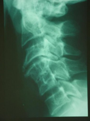 Standard Lateral Plain radiograph of the cervical spine {JPEG}