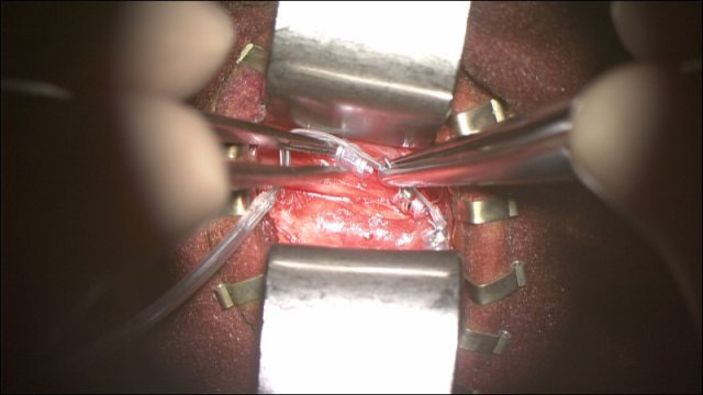 Vue peropératoire. Le nerf vague a été disséqué sur 4 cm environ. On approche l'électrode, tenu par deux pinces de DeBakey. 